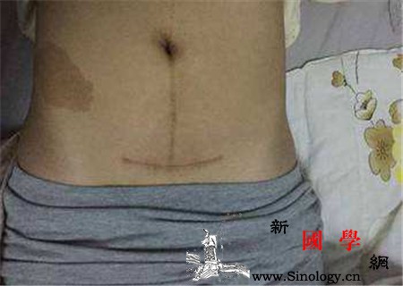 剖腹产横切可以生二胎吗二胎时代得小心_瘢痕-剖腹产-胎儿-产后-