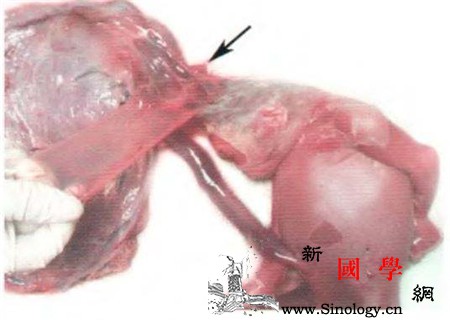 减胎后的胎儿怎么处理不要太惊慌_死胎-胚胎-妊娠-胎儿-