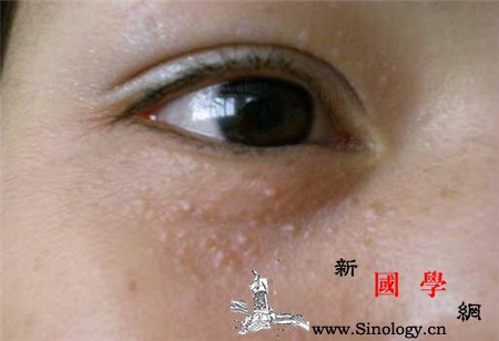 扁平疣的症状表现_瘢痕-扁平疣-丘疹-消退-