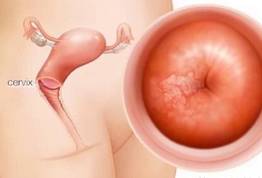 宫颈松弛导致反复流产不如孕前“扎扎紧”_宫颈-孕期-松弛-阴道-孕前检查