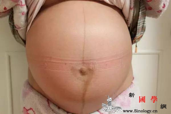 想知生男生女？看妊娠线到底准不准_肚脐-孕期-妊娠-怀孕-生男生女