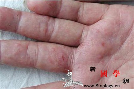 汗疱疹能自愈吗_软膏-脱皮-霉菌-疱疹-
