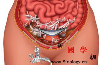 预防剖宫产粘连的中国专家共识（2016）_粘连-手术-剖宫产-腹膜-