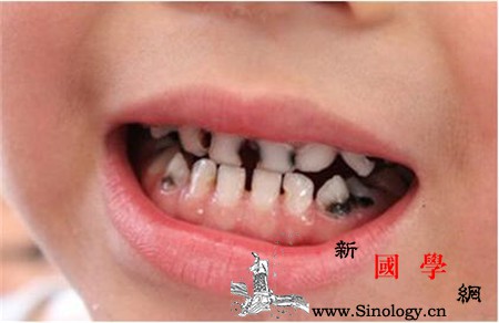 儿童龋齿怎么办_牙髓-补牙-龋齿-细菌-