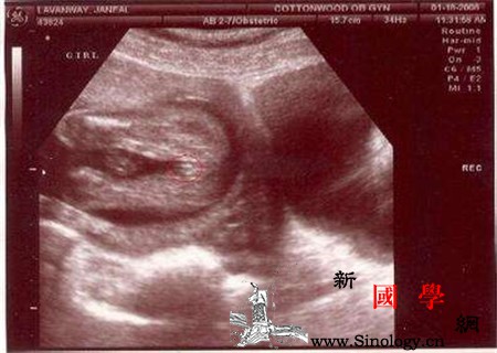孕两个月女宝宝的孕囊图片孕囊隐藏的秘密要知_知晓-孕妇-形状-隐藏-生男生女