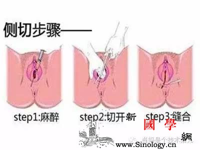 新妈会阴侧切要这样护理大热天感染就麻烦了！_会阴-冲洗-愈合-护理-