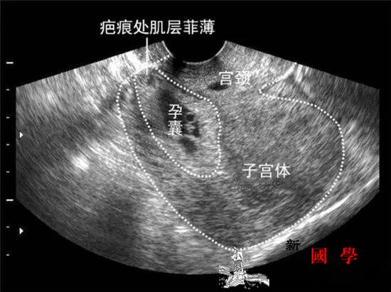 一胎剖宫产二胎妈妈差点子宫破裂瘢痕妊娠的_瘢痕-妊娠-子宫-破裂-