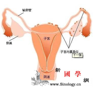 子宫内膜异位症如何诊断？治疗子宫内膜异位症的_子宫-前列腺素-冷敷-热饮-孕前检查