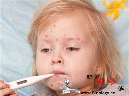 治疗水痘的偏方_荆芥-芫荽-连翘-水痘-