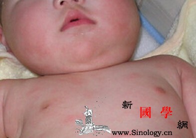 治疗小儿荨麻疹的民间偏方_荆芥-瘙痒-防风-荨麻疹-