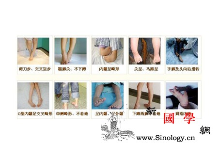 脑瘫宝宝姿势异常图_屈曲-上肢-坐位-伸直-