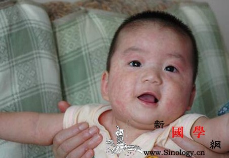幼儿急疹和痱子的区别_丘疹-皮疹-痱子-汗液-