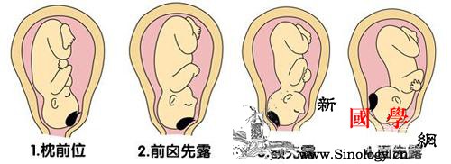胎位不正的原因有哪些_经产妇-胎位-头先-骨盆-