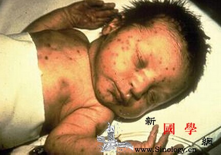 幼儿急疹与风疹的区别_风疹-丘疹-皮疹-发热-