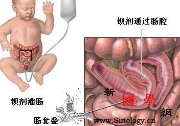 肠套叠最常见的类型_肠套叠-盲肠-结肠-肠道-