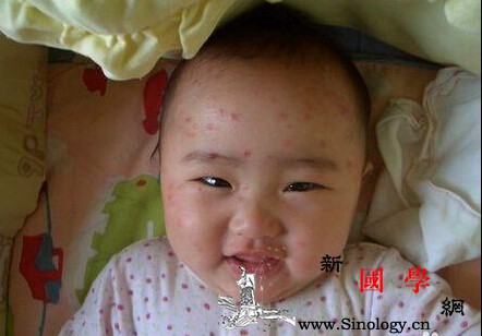 幼儿急疹和水痘的区别_疹子-丘疹-水痘-躯干-