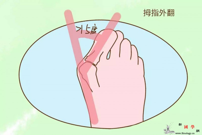 拇指外翻一定会遗传吗？女性需警惕因为不只是_拇趾-孕期-拇指-遗传-遗传优生