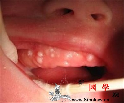 婴儿马牙是什么？_红汞-乳牙-黏膜-脱落-