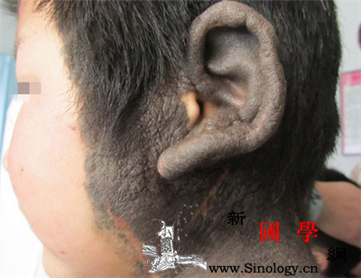 兽皮痣会遗传吗？_恶变-兽皮-癌变-遗传-