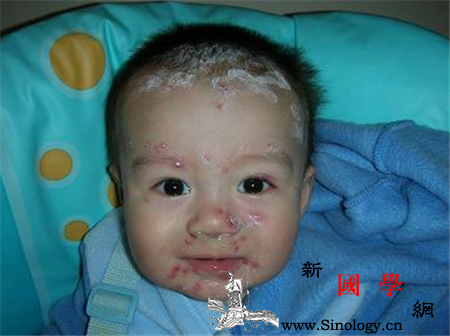 宝宝出水痘有什么症状？_丘疹-水痘-或者是-水泡-