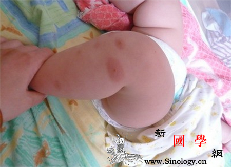 蚊虫叮咬过敏怎么办_钠盐-疟原虫-叮咬-蚊虫-