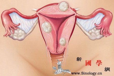 女性痛经是什么原因导致的？警惕子宫内膜异位症_病灶-痛经-子宫-手术-孕前检查