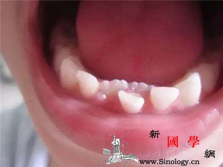 牙齿没掉又长出新牙齿是怎么回事都怪饮食过于_恒牙-长出-乳牙-拔除-