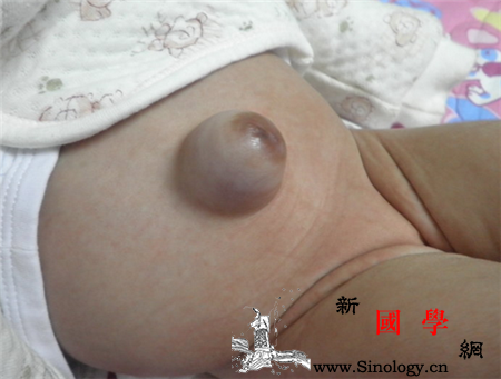 婴儿脐疝的原因_脐带-韧带-根部-脱落-