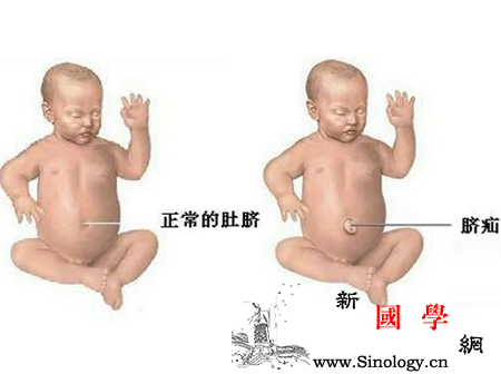 脐疝是什么_腹壁-哭闹-婴幼儿-患儿-