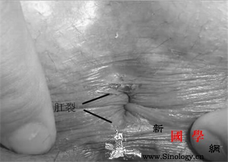 什么是产后肛裂_排便-肛门-分娩-便秘-
