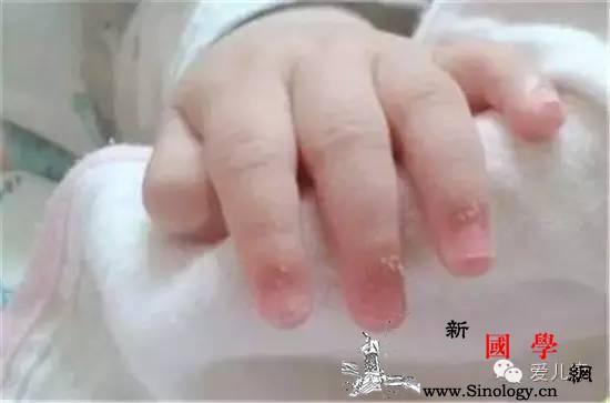 宝宝手指长倒刺是缺了啥？_倒刺-橄榄油-指甲-手指-