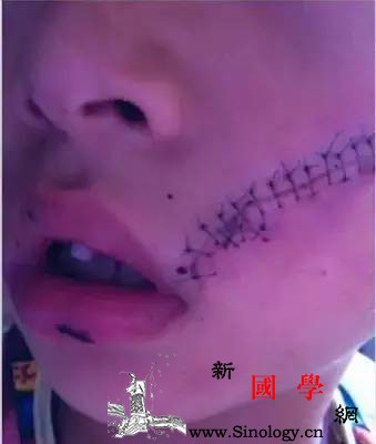 小孩脸上缝了38针冰箱里的这些东西一定不要_碳酸-冷饮-冰箱里-水果-