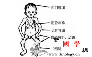 佝偻病能治好吗_日光-佝偻病-矫正-骨骼-