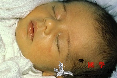 宝宝出生3天黄疸值14mg/dl是新生儿_胆红素-溶血-黄疸-消退-