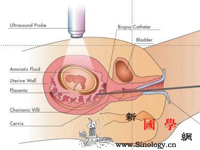 绒毛穿刺怎么做_目的-羊水-子宫颈-穿刺-