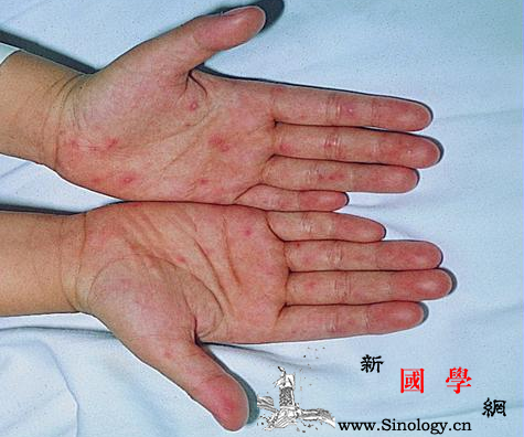 疱疹性咽峡炎会变成手足口吗_咽峡炎-潜伏期-相关文章-手足-