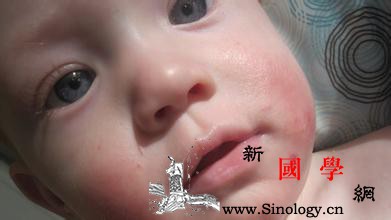 辨别湿疹和痱子图森破！_皮疹-痱子-湿疹-时会-