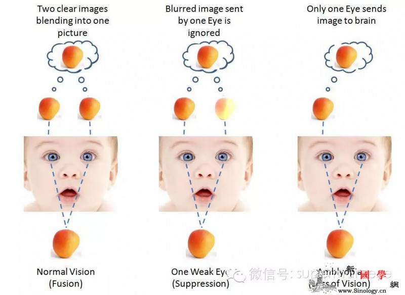 什么是婴幼儿弱视？_弱视-斜视-遮盖-视力-