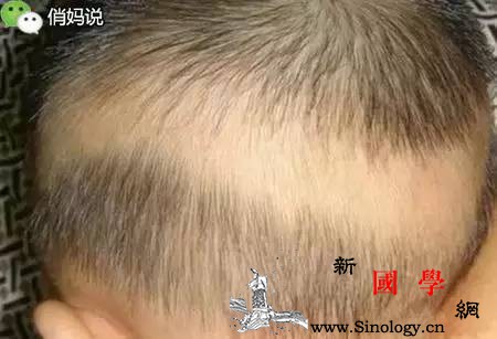 你为什么总担心孩子缺钙？太多妈妈又犯错了！_佝偻病-鱼肝油-维生素-缺钙-