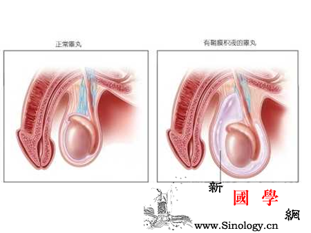 鞘膜积液手术_阴囊-腹腔-睾丸-缝合-