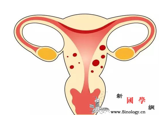 子宫内膜炎有哪些危害？该怎么办？_输卵管-炎症-子宫内-蔓延-孕前检查