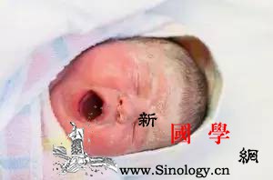 4个月的宝宝头上竟然似长头盔了原来是胎脂_头上-头皮-皮肤-宝宝-