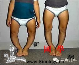 宝宝缺钙？也许你应该先给宝宝补充维生素D_摄入-维生素-补充-检测-