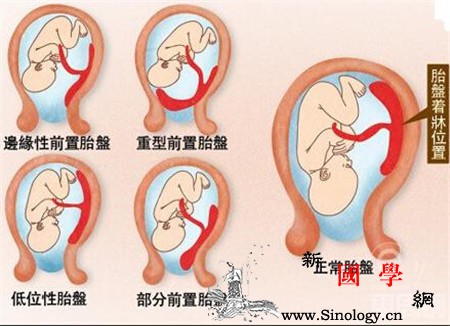 胎盘后壁是什么意思?_孕吐-胎盘-附着-分娩-