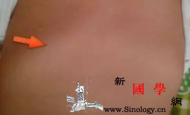 “肋外翻”需要补钙吗？_佝偻病-肋骨-维生素-胸部-