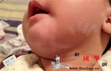 白色糠疹怎么治疗孩子脸上有碍观瞻的白斑_氢化-软膏-硫磺-硅油-