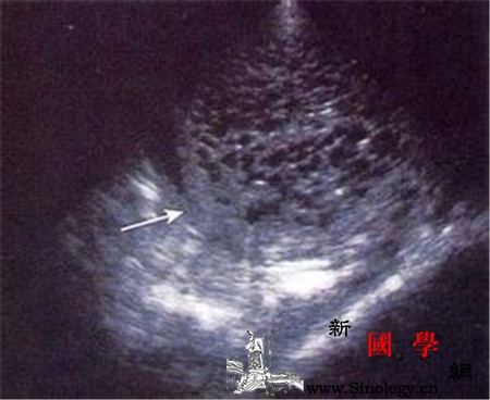 葡萄胎会有胎心吗_葡萄胎-完全性-会有-闭经-