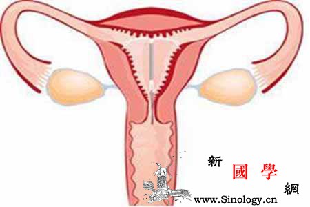 上环的好处和坏处_上环-避孕环-白带-出血-