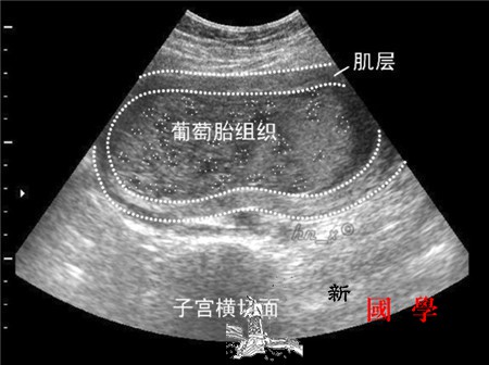 葡萄胎超声表现是怎样的_葡萄胎-菲薄-超声-妊娠-