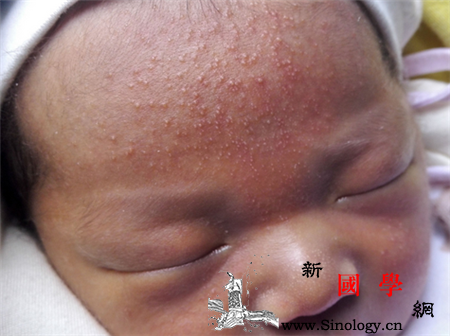 婴儿脸上起小红疙瘩带白头是怎么回事_白点-白头-疙瘩-婴儿-